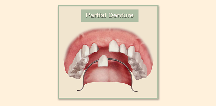 Family Dental Group - Full Dentures